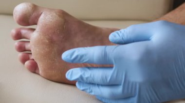 Kuru cilt, ayak sedef hastalığı deri zarar görmüş. Dermatit, egzama, sedef, alerjik reaksiyonlar. Bir adamın bacağının soyulup kırılmasına yakın plan. Mantar enfeksiyonu ya da atlet ayağı, terli ayak.