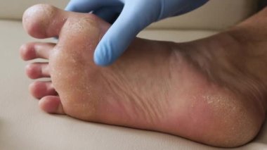 Erkek ayağının kuru derisi, ayağın sedef hastalığı derisi zarar görmüş. Dermatit, egzama, sedef, alerjik reaksiyonlar. İnsan bacağında soyulma ve çatlak teşhisi. Mantar enfeksiyonu ya da atlet ayağı, terli ayak
