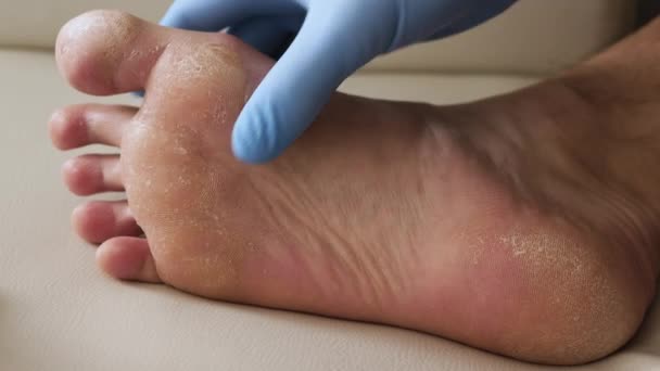 足の乾燥肌 足の乾癬皮膚が破損しています 皮膚炎 アレルギー反応 人間の足の剥離や亀裂の診断 真菌感染症やアスリートの足 汗ばむ足 — ストック動画