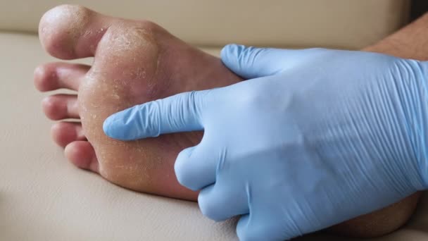 乾燥肌 足の乾癬皮膚が破損しています 皮膚炎 アレルギー反応 人間の足の剥離や亀裂の診断 真菌感染症やアスリートの足 汗ばむ足 — ストック動画