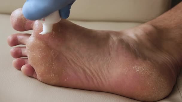 Krém Pro Suchou Pokožku Nohou Psoriázu Nohou Pleť Poškozená Dermatitida — Stock video