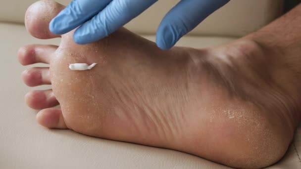 Cremebehandlung Für Trockene Fußhaut Schuppenflechte Die Haut Wird Geschädigt Dermatitis — Stockvideo