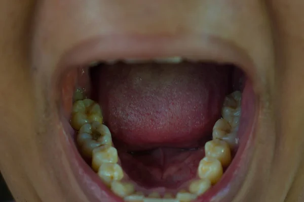 Mužské Zuby Jsou Žluté Neupravené — Stock fotografie