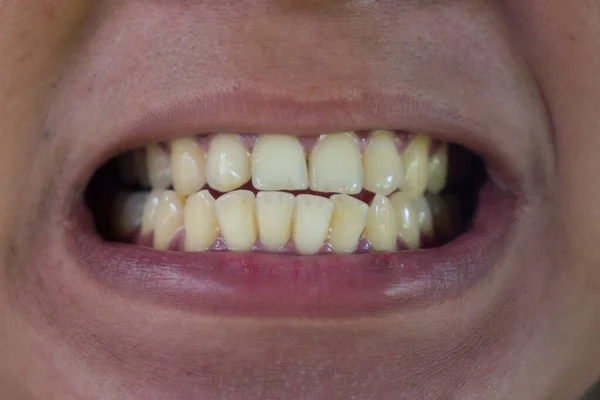 Мужские Зубы Жёлтые Неопрятные — стоковое фото