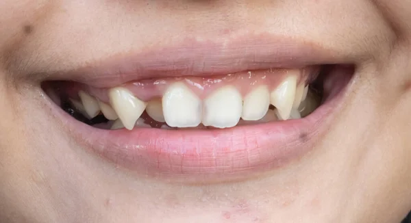 Οδοντωτά Δόντια Μιας Νεαρής Γυναίκας — Φωτογραφία Αρχείου