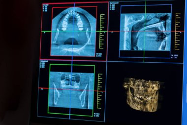 Diş sağlığı kliniğinin bilgisayar ekranında bir hastanın çenesinin röntgen görüntüsünün taranması