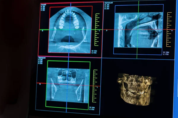 在牙科诊所的电脑屏幕上扫描病人下巴X光片上的牙齿 — 图库照片
