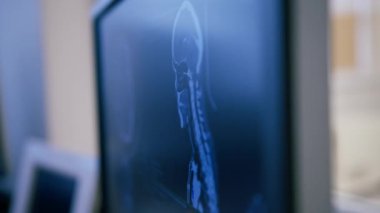 Beyin bilgisayarlı tomografi ile tümör 3 boyutlu görüntüleme ekranda insan vücudu araştırma kliniği