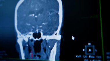 Bilgisayar tomografisi, beyin iltihabı kliniğinde görüntü oluşturma.