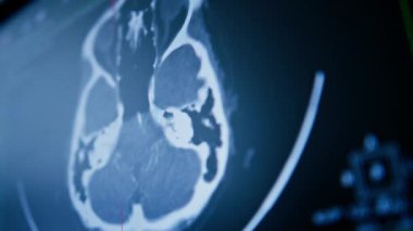 Bilgisayar tomografisi, beyin iltihabı kliniğinde görüntü oluşturma.