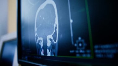 Bilgisayar tomografisi, beyin iltihabı kliniğinde görüntü oluşturma.