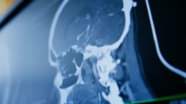 スクリーン脳炎症疾患クリニックのコンピュータトモグラフィー脳3Dレンダリング画像 — ストック動画