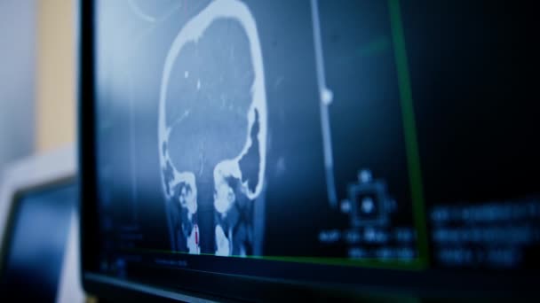 Tomografi Komputer Gambar Rendering Otak Pada Layar Penyakit Peradangan Otak — Stok Video