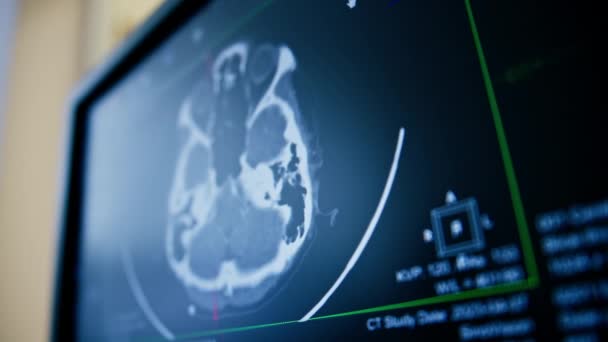 Tomografia Komputerowa Mózg Renderowania Obrazu Ekranie Choroby Zapalnej Mózgu Kliniki — Wideo stockowe