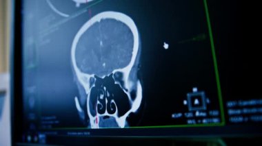 Bilgisayar tomografisi, beyin iltihabı kliniğinde görüntü oluşturma.
