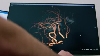 Hasta klinikte bilgisayar tomografisinden geçiyor, radyoloji uzmanı prosedürün gidişatını ve akciğer taramasının sonuçlarını izliyor.