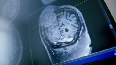 Bilgisayar tomografisi, beyin iltihabı kliniğinde görüntü oluşturma.