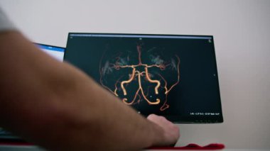 Hasta klinikte bilgisayar tomografisinden geçiyor, radyoloji uzmanı prosedürün gidişatını ve akciğer taramasının sonuçlarını izliyor.