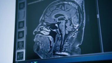 Bilgisayar tomografisi, beyin iltihabı kliniğinde görüntü oluşturma.