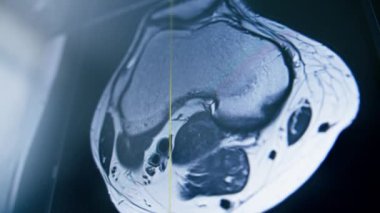Bilgisayar tomografisi, beyin iltihabı kliniğinde görüntü oluşturma.
