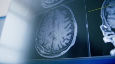 Bilgisayar tomografisi, beyin iltihabı kliniğinde görüntü oluşturma.