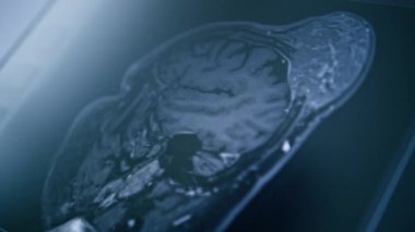 Bilgisayar tomografisi, beyin iltihabı kliniğinde görüntü oluşturma.