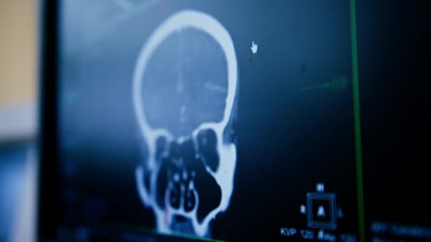 Tomografia Komputerowa Mózg Renderowania Obrazu Ekranie Choroby Zapalnej Mózgu Kliniki — Wideo stockowe