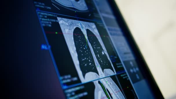 病人在诊所接受电脑断层扫描时 放射科医生会监察手术的进展及肺扫描的结果 — 图库视频影像