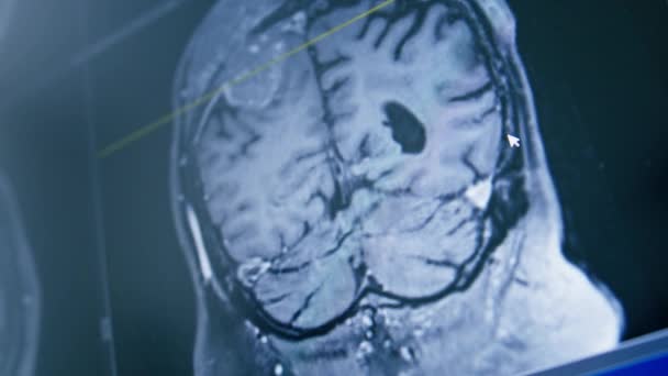 Computertomographie Gehirn Rendering Bild Auf Dem Bildschirm Gehirnentzündung Krankheit Klinik — Stockvideo