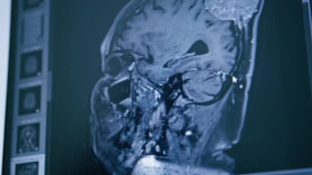 Tomografi Komputer Gambar Rendering Otak Pada Layar Penyakit Peradangan Otak — Stok Video