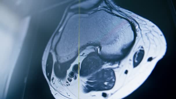 Tomografia Computadorizada Cérebro Imagem Renderização Tela Cérebro Inflamação Doença Clínica — Vídeo de Stock