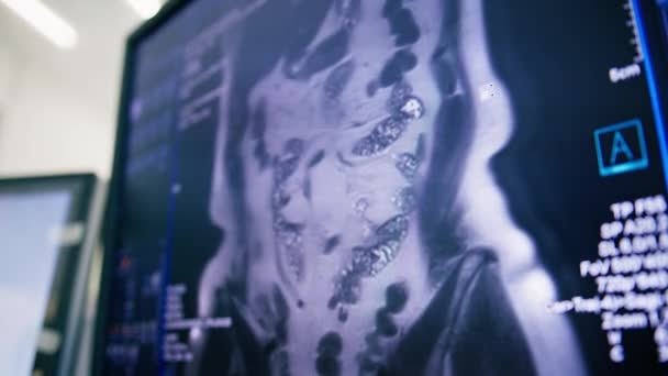 Počítačová Tomografie Mozek Vykreslování Obraz Obrazovce Zánětlivé Onemocnění Mozku Klinika — Stock video