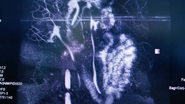 Компьютерная Томография Мозг Рендеринг Изображения Экране Мозга Воспаление Клиники — стоковое видео