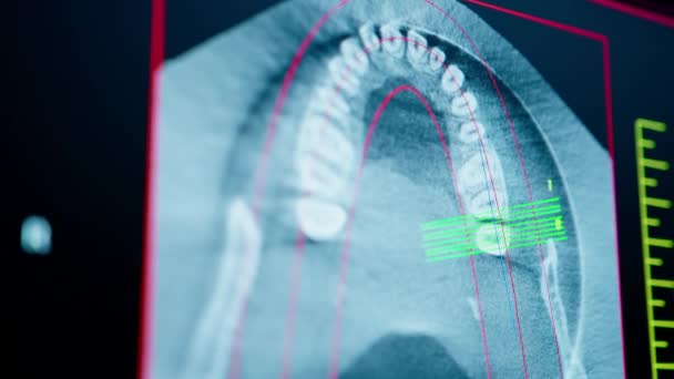 Skenování Zubů Rentgenovém Snímku Čelisti Pacienta Počítačové Obrazovce Škálování Zubní — Stock video