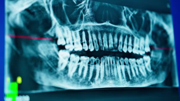 在牙科诊所的电脑屏幕上扫描病人下巴X光片上的牙齿 — 图库视频影像
