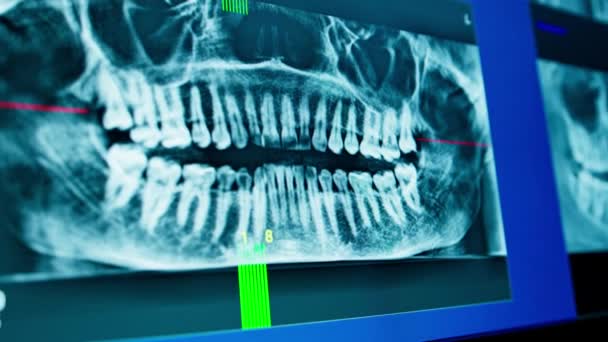 Skanowanie Zębów Zdjęciu Rentgenowskim Szczęki Pacjenta Ekranie Komputera Skalowanie Dentystycznej — Wideo stockowe