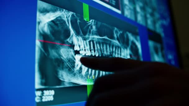 コンピュータ画面で患者の顎のX線画像をスキャンし 歯列歯科医院の医師は病気の歯を示しています — ストック動画