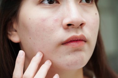 Acne pimple and scar on skin face, disorders of sebaceous glands, teenage girl skincare beauty problem.