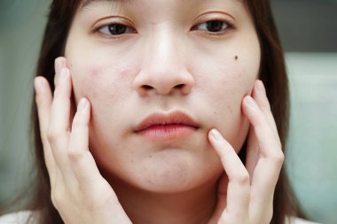 Acne pimple and scar on skin face, disorders of sebaceous glands, teenage girl skincare beauty problem.