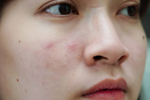 Acne Pimple Scar Skin Face Disorders Sebaceous Glands Teenage Girl — Stock Fotó
