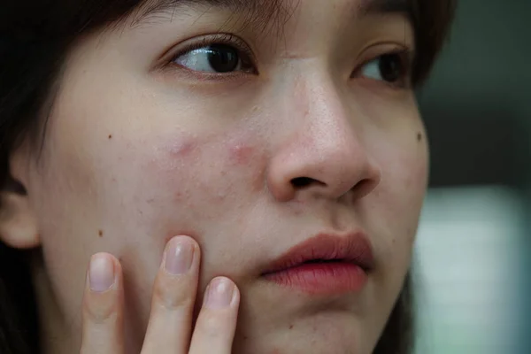 Acne Pimple Scar Skin Face Disorders Sebaceous Glands Teenage Girl — Foto de Stock