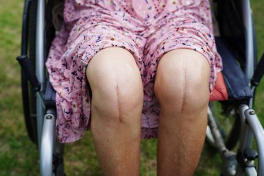 Asyalı yaşlı kadın engelli hasta Walker 'la birlikte hemşire hastanesinde yürüyor..