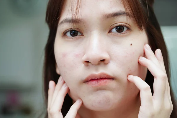 Acne pimple and scar on skin face, disorders of sebaceous glands, teenage girl skincare beauty problem.
