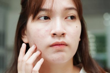 Acne pimple and scar on skin face, disorders of sebaceous glands, teenage girl skincare beauty problem.