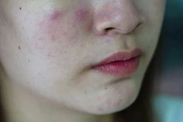 Acne Pimple Scar Skin Face Disorders Sebaceous Glands Teenage Girl — Photo