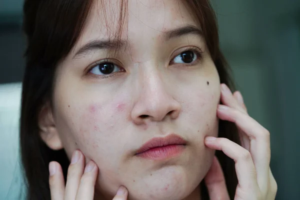 Acne Pimple Scar Skin Face Disorders Sebaceous Glands Teenage Girl — 图库照片