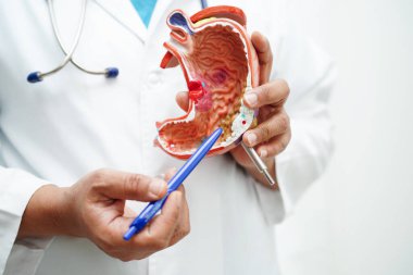 Mide hastalığı, hastanede teşhis ve tedavi için anatomi modeli tutan bir doktor..
