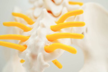 Omurga ve kemik, bel kemiği yerinden oynamış disk parçası, ortopedi bölümünde tedavi için model.