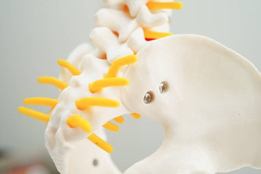Omurga ve kemik, bel kemiği yerinden oynamış disk parçası, ortopedi bölümünde tedavi için model..