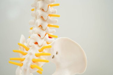 Omurga ve kemik, bel kemiği yerinden oynamış disk parçası, ortopedi bölümünde tedavi için model..